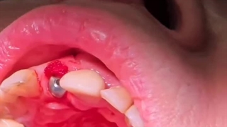 جراحی ایمپلنت در 5 دقیقه