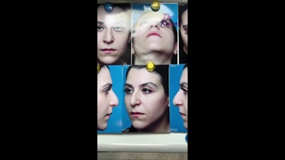 قبل و بلافاصله پس از عمل زیبایی بینی همراه با ورم زیاد