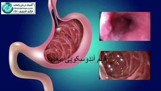 فیلم آندوسکوپی معده - clinicdarman.com