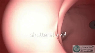 فیلم برداشتن پولیپ روده- کلینیک پایتخت