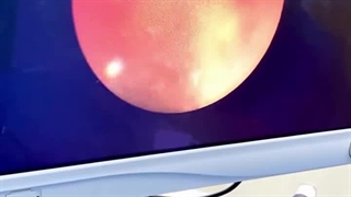 درمان آندوسکوپی سنگ حالب