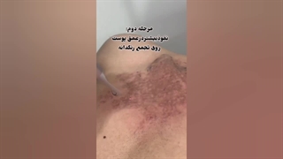 کربن تراپی توسط لیزر کیوسوییچ (1) ارتودنسی