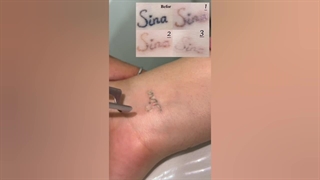 پاک کردن تاتو (تتو) با لیزر کیوسوییچ (2)