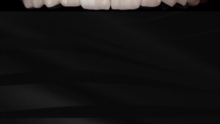 اصلاح خط لبخند به وسیله ترکیبی از لمینت و روکش های سرامیکی