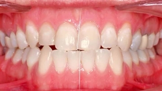 دکتر علی حیدری پوسیدگی دندان