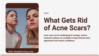 What Gets Rid of Acne Scars?