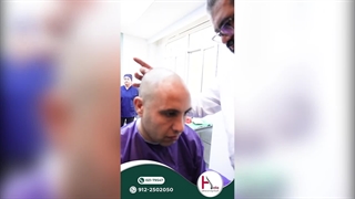 کاشت مو برای هر الگوی طاسی