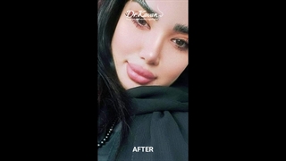 قبل و بعد عمل زیبایی بینی