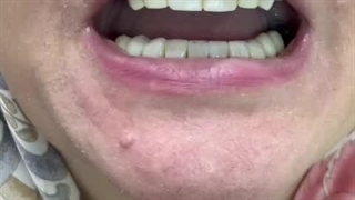 فیلم گذاشتن پارسیل فک بالا: 20% تخفیف زمستانه