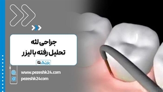 فیلم جراحی لبخند لثه ای با لیزر