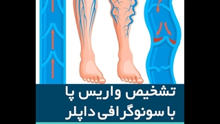 تشخیص واریس با سونوگرافی داپلر
