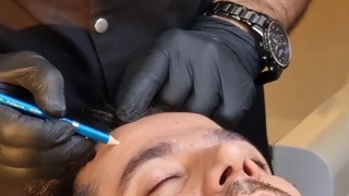 تزریق بوتاکس آقایان در فردیس