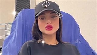 تزریق ژل لب