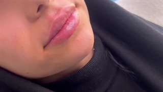 بهترین تزریق فیلر لب در فردیس