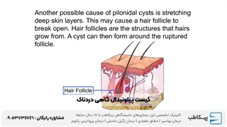 درمان و عمل کیست مویی در 20 دقیقه | لیزر کیست مویی