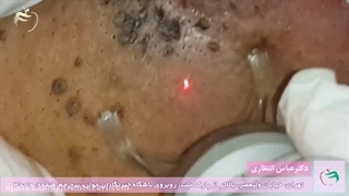 فیلم لیزر زگیل تناسلی مردان