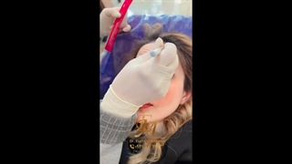 تزریق بوتاکس جراحی پف زیر چشم