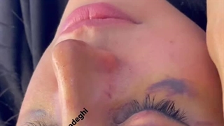 دکتر علی اکبر صادقی عمل بینی گوشتی مشهد | سایت بهترین در مشهد لیزر صورت