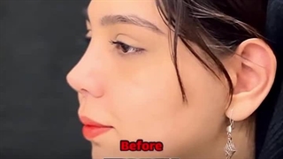 دکتر الهام ایمانی عمل بینی گوشتی مشهد | سایت بهترین در مشهد