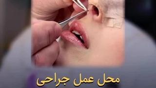 دکتر ناصری صدر عمل بینی گوشتی مشهد | سایت بهترین در مشهد