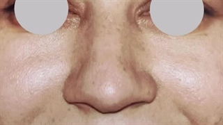 دکتر محمد اکبریان عمل بینی گوشتی مشهد | سایت بهترین در مشهد