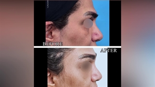 رفع الحاجب بالمنظار فی إیران