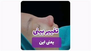 نمونه‌های قبل و بعد از عمل بینی در مشهد: نتایج واقعی مراجعین!