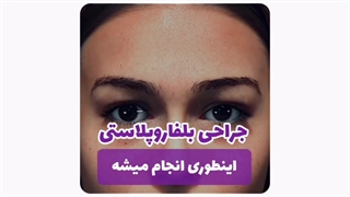 انیمیشن جراحی بلفاروپلاستی: مراحل عمل پلک به زبان ساده!