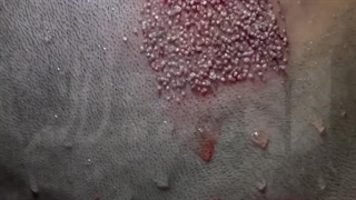 کلینیک کاشت مو لاله