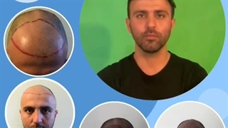 کلینیک کاشت مو آسمان