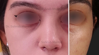 تجمیل الأنف - أفضل جراح أنف فی إیران