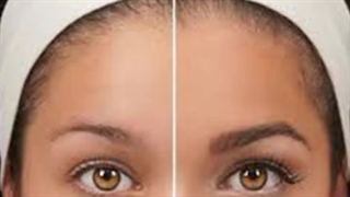 کاشت ابرو طبیعی و نمونه های آن در کلینیک آنیل