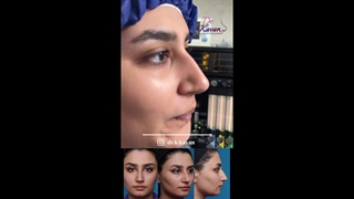 قبل و بلافاصله پس از عمل زیبایی بینی همراه با ورم زیاد