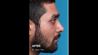 قبل و بعد عمل زیبایی بینی