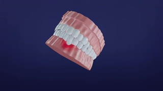 مراحل ایمپلنت دندان