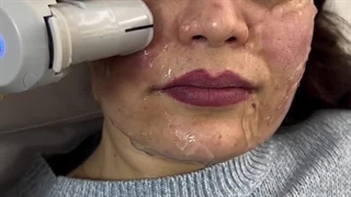 هایفوتراپی کاشت ابرو