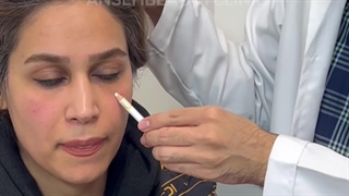 تزریق فیلر زیر چشم