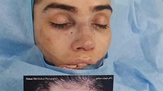 تجمیل الأنف - أفضل جراح تجمیل فی إیران