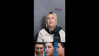 رضایت زیباجو از عمل زیبایی بینی