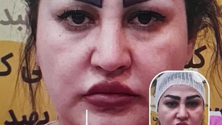 ویدیو کاشت ابرو طبیعی و دائمی | روش‌های نوین در کلینیک بهبد