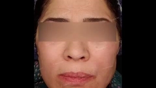 کشیدن و تزریق چربی با دستگاه پزشکی Lipo Modeling
