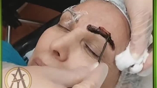 ریموو تتوی قدیمی در آکادمی آیلا برته