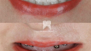 ایمپلنت فول فک دکتر سامان کلانتری