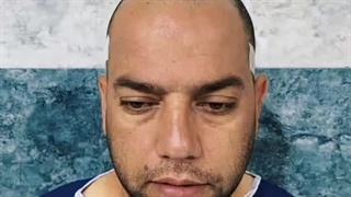 کلینیک کاشت مو گلبرگ بوشهر