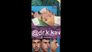 عمل بینی مردانه - بعد از جراحی همراه با ورم زیاد