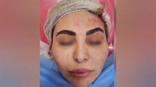 انجام لیفت ابرو با نخ دو سوزنه