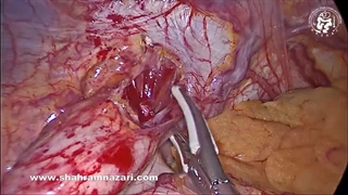 عمل جراحی اصلاحی در آشالازی عودکرده