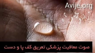 معافیت پزشکی تعریق کف دست و پا