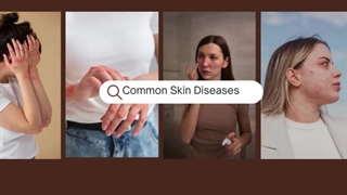 Common Skin Diseases : Best Solution At Dosepharmacy