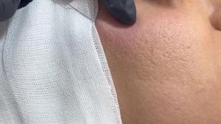 سابسیژن به همراه مزونیدلینگ